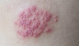 ​带状疱疹痛感10级 什么是带状疱疹？