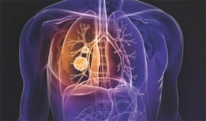 将肺癌筛查列入医保 能降低人们的医疗成本吗？