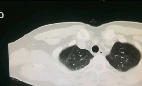 痰鸣音和哮鸣音的区别 