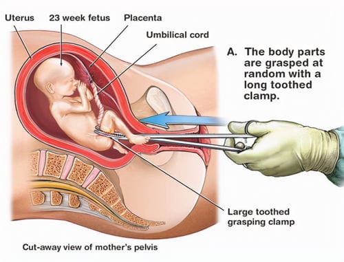 美国 6周后禁堕胎 原本为保护女性,孕产妇死亡率却为何更高