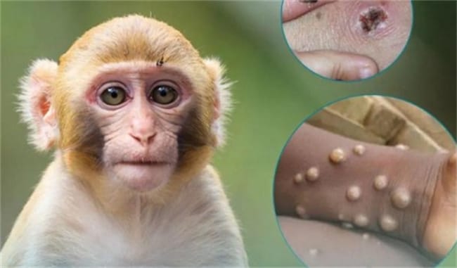 北京发现两例猴痘病例 有什么影响呢？