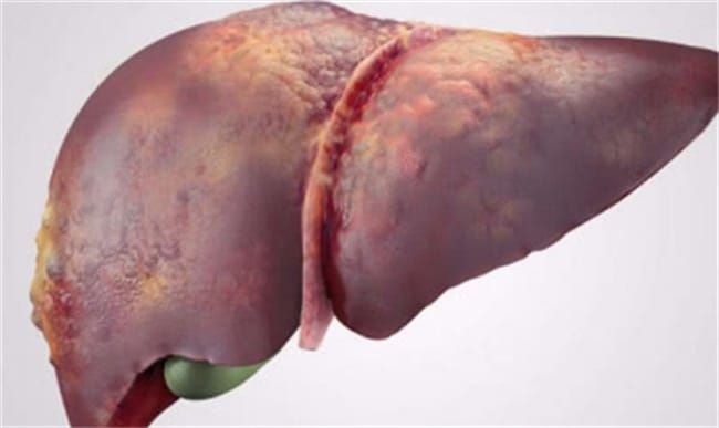​肝脏囊肿是什么原因造成的 有哪些危害