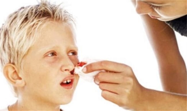 儿童流鼻血现象频发 应该如何止血？