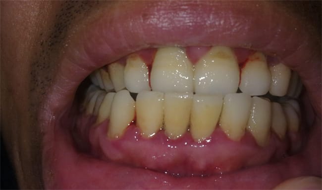 牙龈过敏该怎么办 牙龈过敏要吃什么药