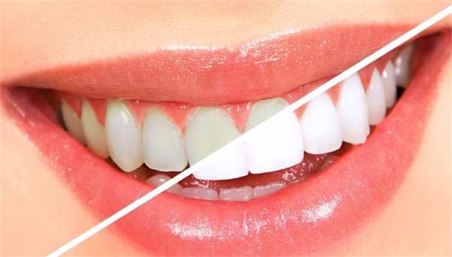 洗牙可以美白牙齿吗 美白牙齿有什么方法