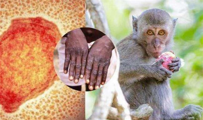 猴痘能治好吗 猴痘是什么病