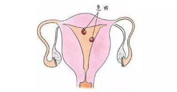梁雪芳 子宫有内膜息肉,是先怀孕还是先手术