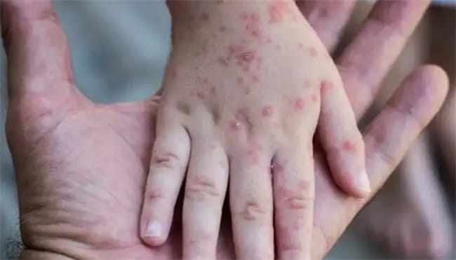 ​猴痘的皮疹最先出现的部位 猴痘的皮疹特点有哪些