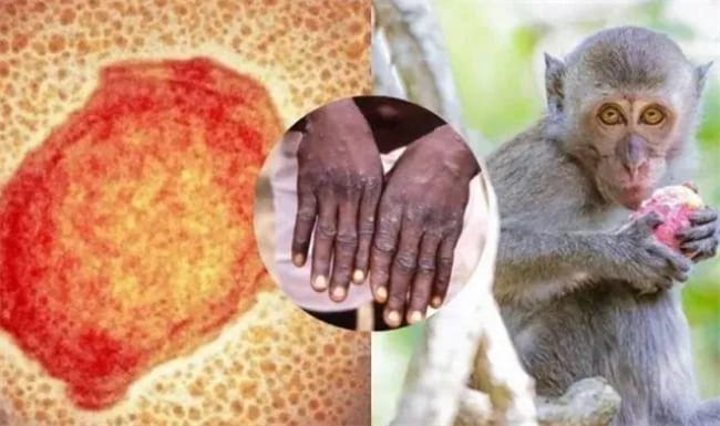 猴痘会导致死亡吗 猴痘有哪些症状