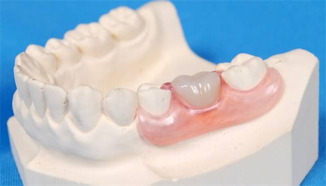 拔牙后多久可以镶牙 镶牙是怎样流程
