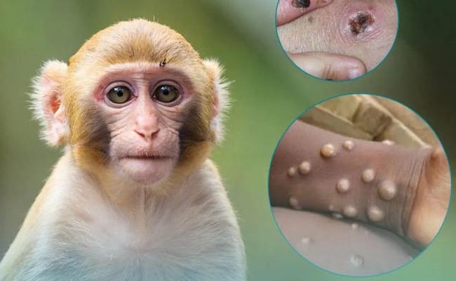 “猴痘”是什么 有哪些传播途径