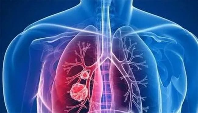 肺结节一般能活多少年 什么是肺结节