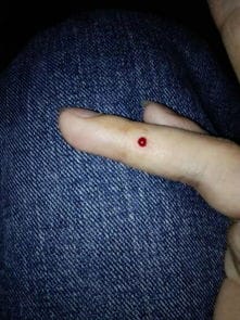 手指上长期有个血点,剪破后就血流不止是什么问题阿 就像那个点里面的血压很高顶了个血点出来,不痛不痒 