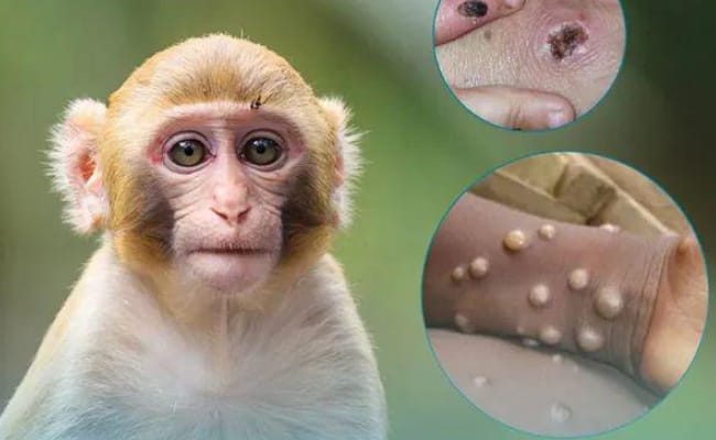 已有152例猴痘病例死亡 要如何预防猴痘呢