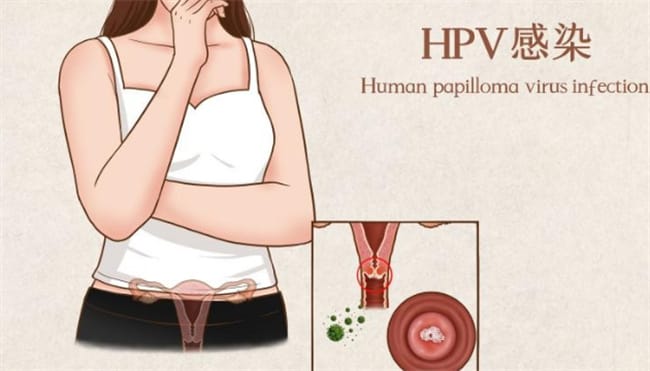 HPV是什么 HPV的怎么传染