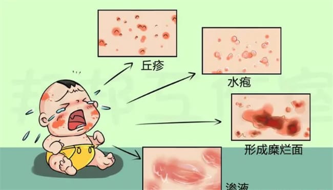 ​婴儿湿疹症状有哪些 婴儿湿疹怎么办