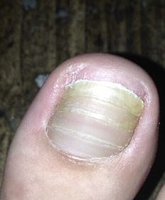 大拇指脚趾甲有断层是什么原因 