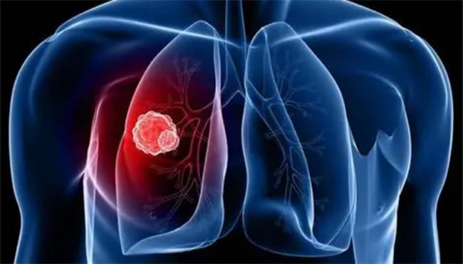 肺癌的早期症状有什么 肺癌形成的病因是什么