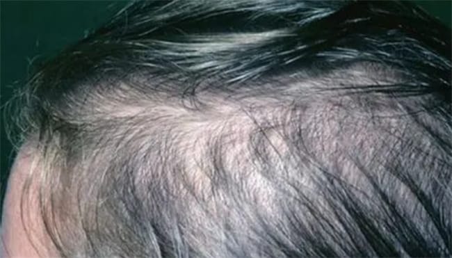 ​神经性脱发的症状表现有什么 神经性脱发是什么