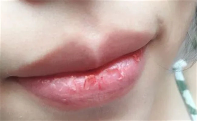 反复口腔溃疡嘴唇起皮是什么原因   嘴唇起皮是什么原因 