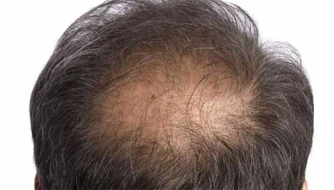 ​神经性脱发的症状表现有什么  神经性脱发是什么