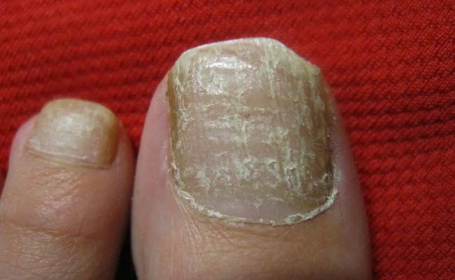 灰指甲容易传染吗  灰指甲能治好吗