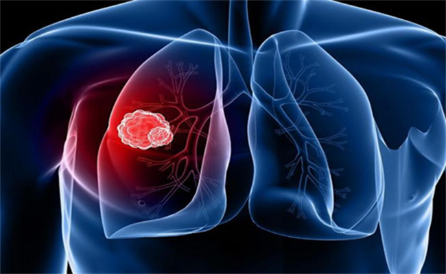 肺癌早期除了干咳还有哪2个表现  早期肺癌能治吗