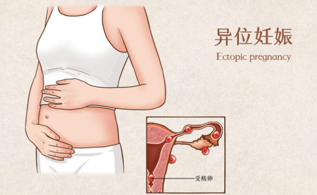 胚胎移植后宫外孕有哪些症状  宫外孕是什么