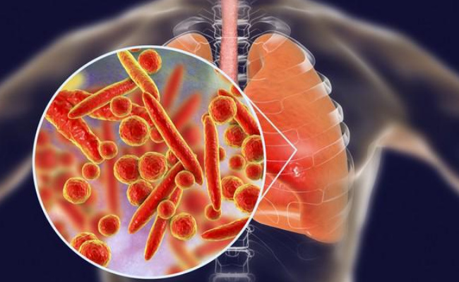 ​什么是肺炎支原体感染 出现哪些症状要提高警惕 怎样做好防治