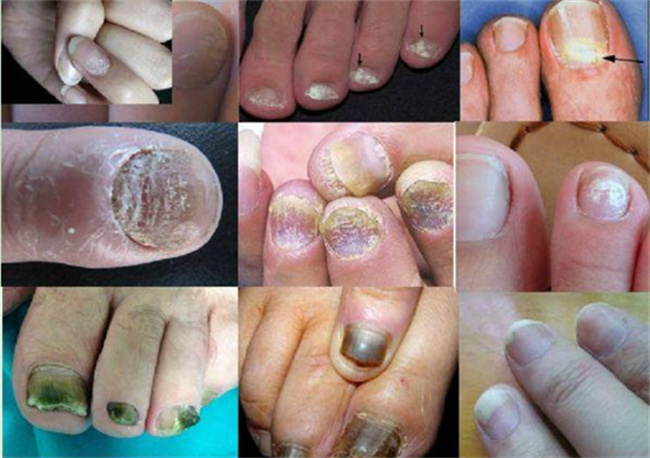 灰指甲是什么原因造成的 灰指甲怎么治疗