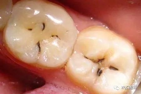 你的牙齿上有没有黑线 这是牙齿坏掉的第一个征兆