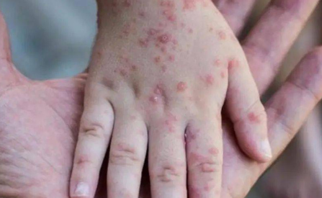 10月新增报告127例猴痘确诊病例 要如何预防