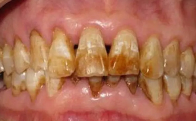 24岁男子3颗烂牙没治感染大脑 牙齿不健康的危害