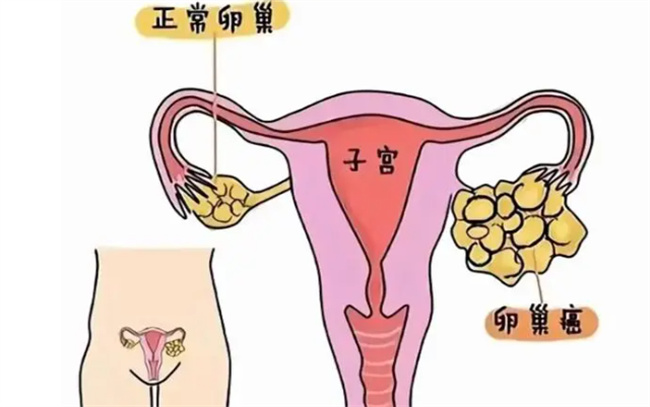 卵巢癌为什么是妇癌之王，哪些信号是卵巢癌
