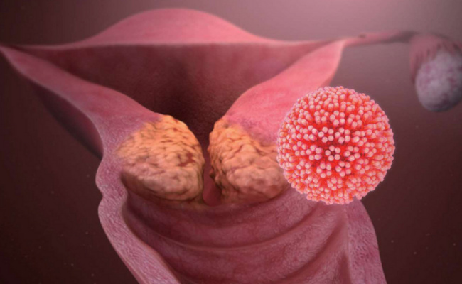 高危型HPV持续感染会引发宫颈癌吗，宫颈癌的形成有哪些原因