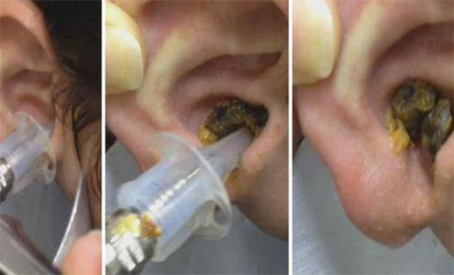耳屎多的原因，耳朵的清理有哪些方法