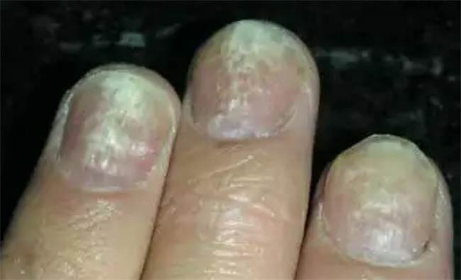 指甲出现哪4个症状可能是大病，指甲异常是大病的征兆吗